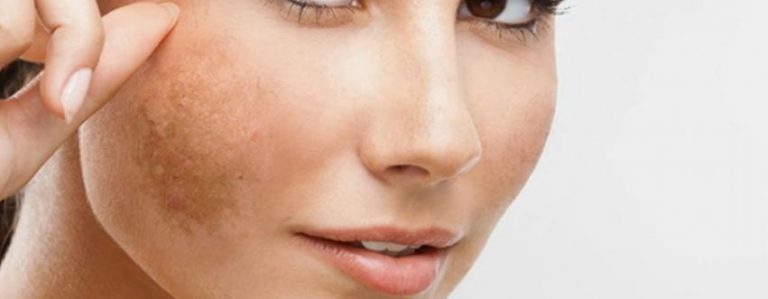 Melasma Causes Symptoms And Diagnosis Barbara B Jones