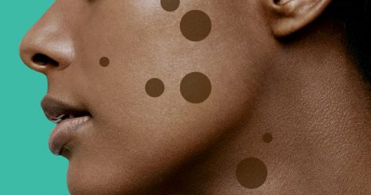 how-to-get-rid-of-black-spots-at-home-barbara-b-jones